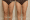 thread lift legs before and after
